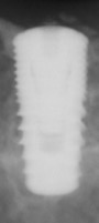 Radiograph of Dentis