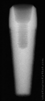 Radiograph of Endopore
