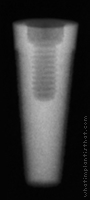 Radiograph of Endopore