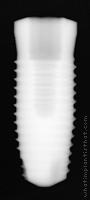 Radiograph of Endure Fixture CP