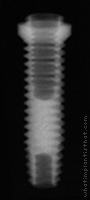 Radiograph of Entegra Screw
