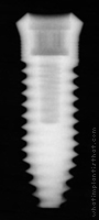 Radiograph of Esthetic Region Implant (ERI)
