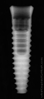 Radiograph of Esthetic Region Implant (ERI)