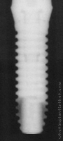 Radiograph of External RBT D3 Threadform