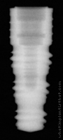 Radiograph of Friadent Frialit-2