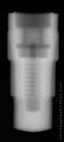 Radiograph of Friadent Frialit-2 Stepped Cylinder