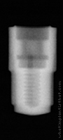 Radiograph of Friadent Frialit-2 Stepped Cylinder