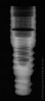 Radiograph of Friadent Frialit-2 Synchro