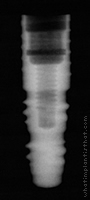 Radiograph of Friadent Frialit-2