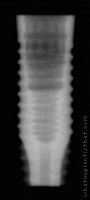 Radiograph of Full OSSEOTITE Parallel Walled Certain