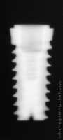 Radiograph of Hati