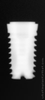Radiograph of Hati