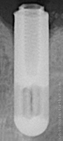 Radiograph of IMZ Hex Head