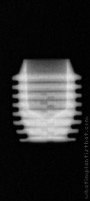 Radiograph of I-system | I-SF 5006 (3)