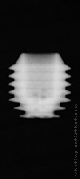 Radiograph of Integra-CP (3.0mm Well)