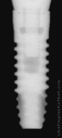 Radiograph of Internal RBT