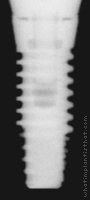 Radiograph of Internal RBT