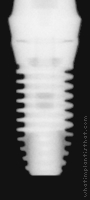 Radiograph of Internal RBT