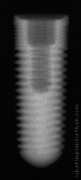 Radiograph of Legacy 1