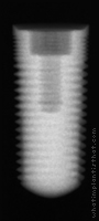 Radiograph of Legacy 1