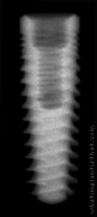Radiograph of Legacy 2