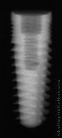 Radiograph of Legacy 2