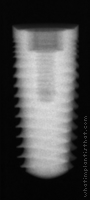 Radiograph of Legacy 2