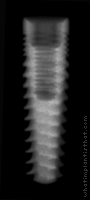Radiograph of Legacy 2