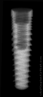 Radiograph of Legacy 3