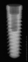 Radiograph of Legacy 3