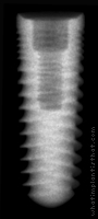 Radiograph of Legacy 3