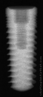 Radiograph of Legacy 3