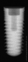 Radiograph of Legacy 3