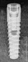 Radiograph of Legacy 3