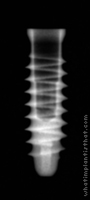 Radiograph of Exacone Max Stability