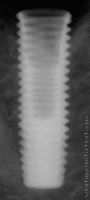 Radiograph of EZ Plus