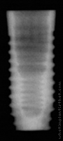 Radiograph of NanoTite Parallel Walled Certain