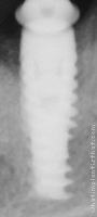 Radiograph of Drive CM