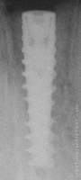 Radiograph of NobelActive Internal NP