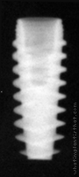 Radiograph of NobelActive Internal RP