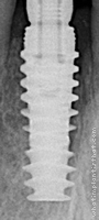 Radiograph of NobelActive Internal