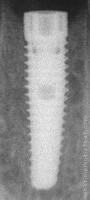 Radiograph of NobelReplace Tapered Groovy NP