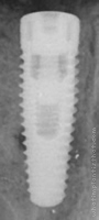 Radiograph of NobelReplace Tapered Groovy RP
