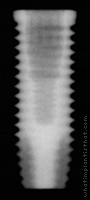 Radiograph of OSSEOTITE Certain PREVAIL