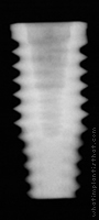 Radiograph of OSSEOTITE Certain PREVAIL