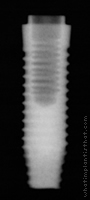 Radiograph of OSSEOTITE Parallel Walled