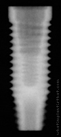 Radiograph of OSSEOTITE Parallel Walled Certain