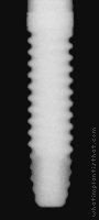 Radiograph of OVD Implant 2mm collar RBT