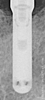 Radiograph of Calcitek Omniloc