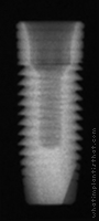 Radiograph of OsseoLink